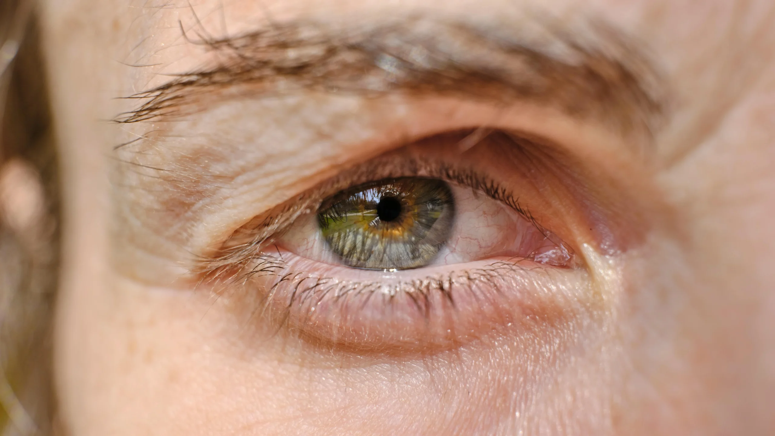 age related macular degeneration