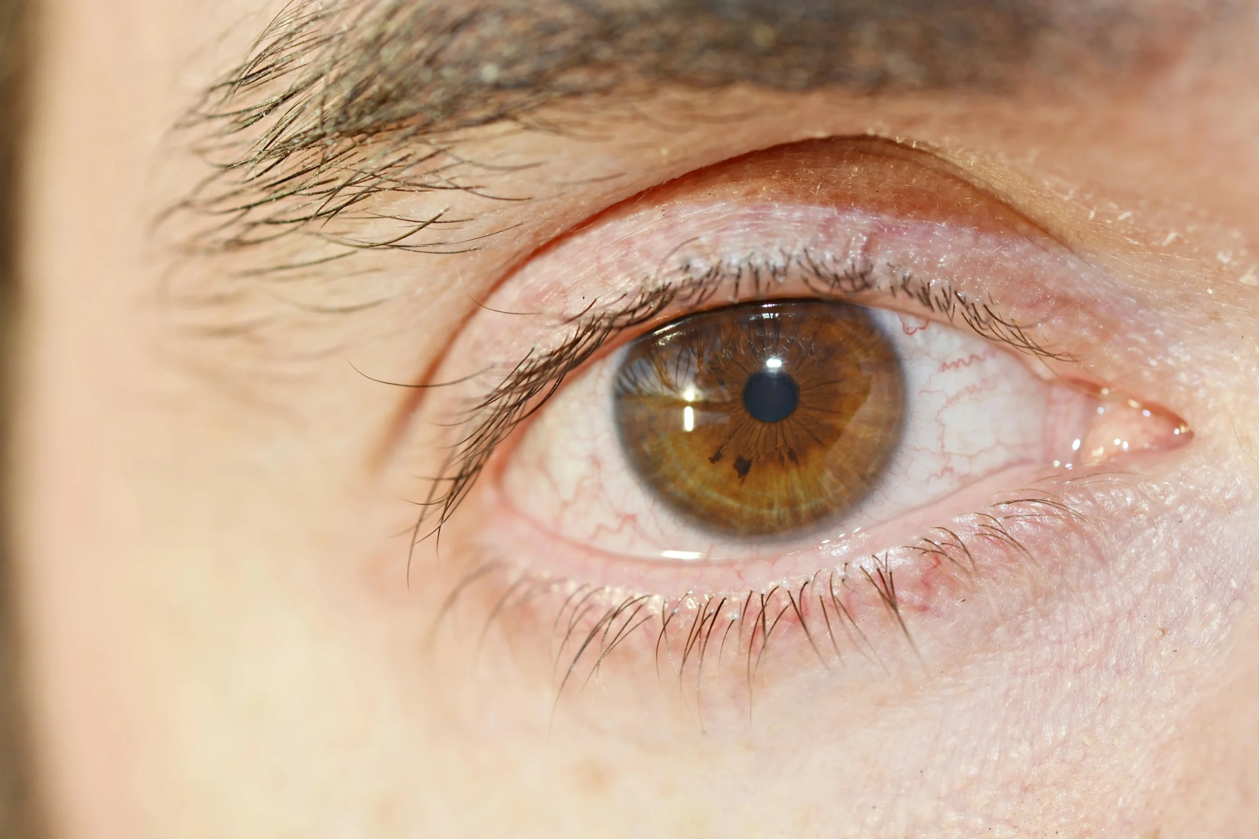 diabetic retinopathy