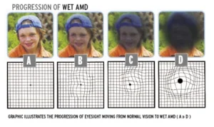 different macular degeneration eyesight
