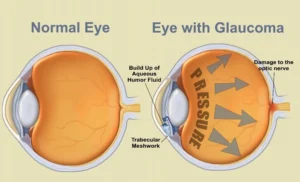 glaucoma eye