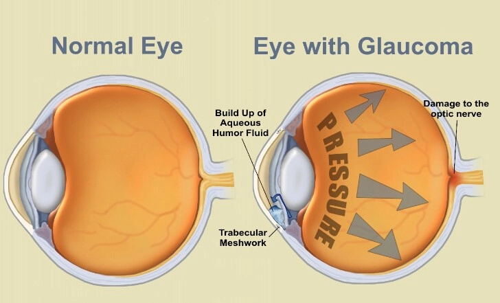 glaucoma eye