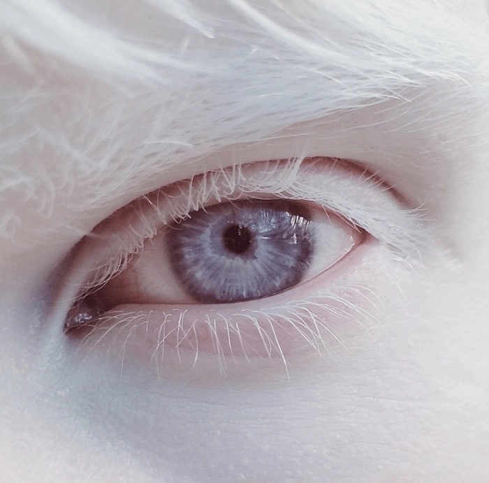 what is albinism