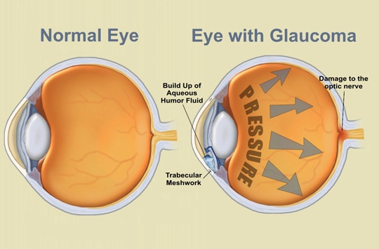 primary open angle glaucoma 1
