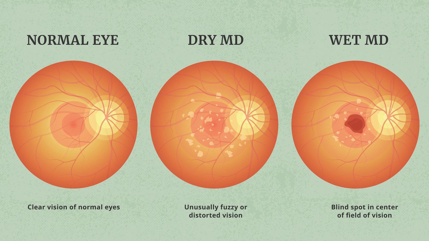 wet vs dry age related macular degeneration