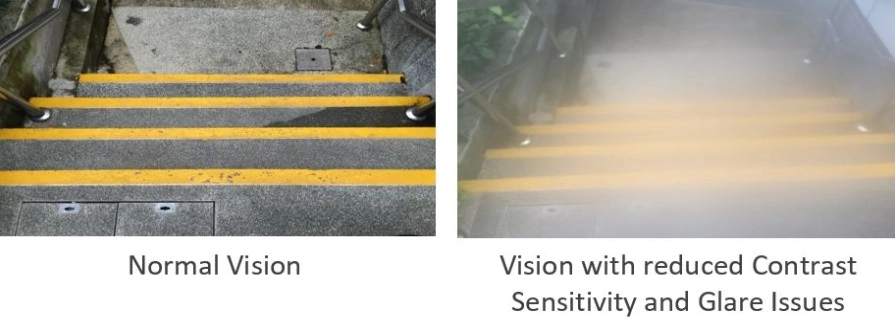 reduced contrast sensitivity and glare lssues