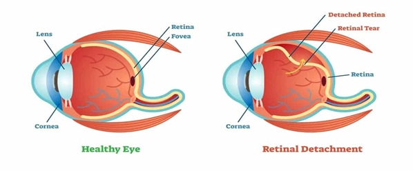 retinal detachment condition